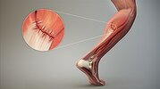 3D_Medical_Animation_Depicting_Strain-Tendon.jpg